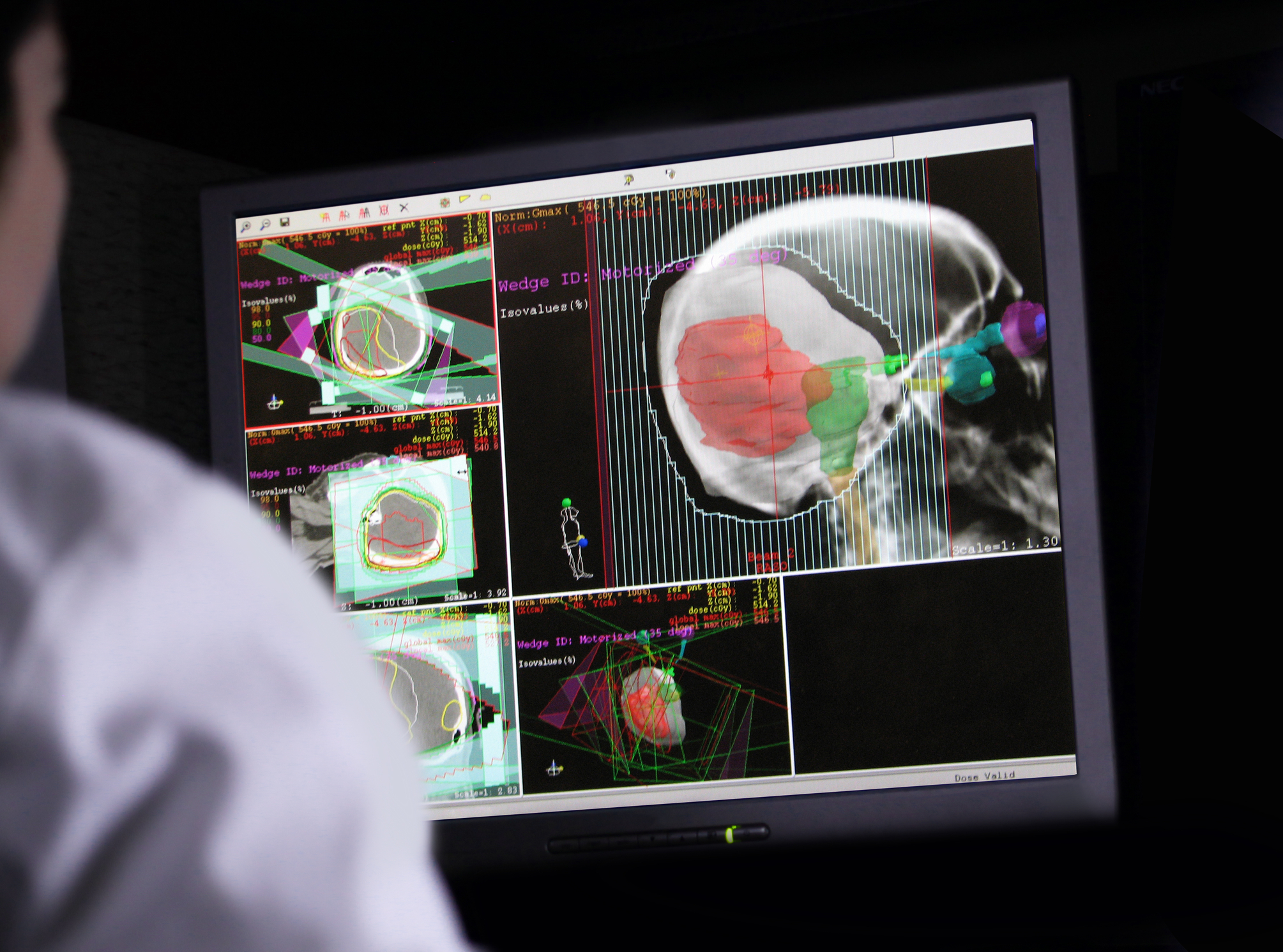 doctor looking at brain scan on screen